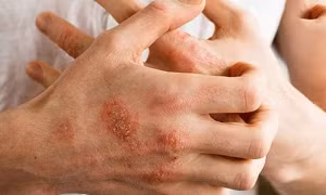 Giao mùa thận trọng với dị ứng thời tiết