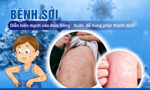 Không chủ quan với bệnh sởi có nguy cơ bùng phát