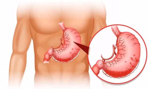 Điểm mặt các dấu hiệu bất thường về đau dạ dày cần tới bác sĩ