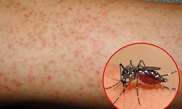 Mẹ bầu mắc sốt xuất huyết có nguy hiểm cho thai nhi?