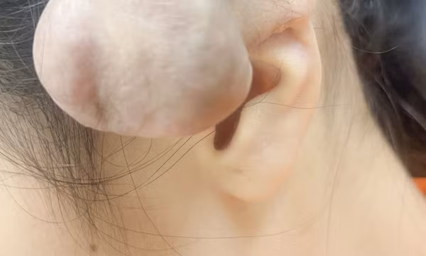 Xỏ khuyên, bấm nhiều lỗ trên vành tai dễ dẫn đến nhiều hệ luỵ