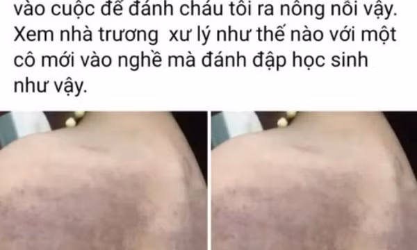 Tạm đình chỉ công tác cô giáo đánh bầm vai, lưng học sinh lớp 3
