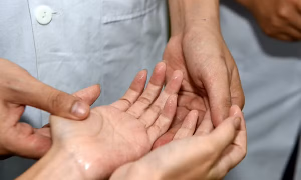 Giải pháp hỗ trợ điều trị giảm đổ mồ hôi tay hiệu quả