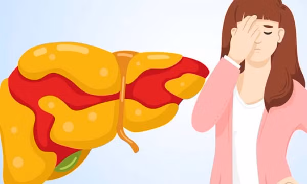 Gan nhiễm mỡ có thể ảnh hưởng đến sức khỏe của mắt