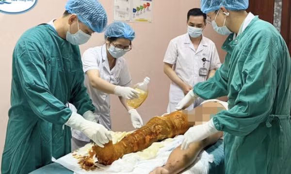Tự làm thí nghiệm đốt cồn tại nhà, bé trai 12 tuổi bỏng nặng