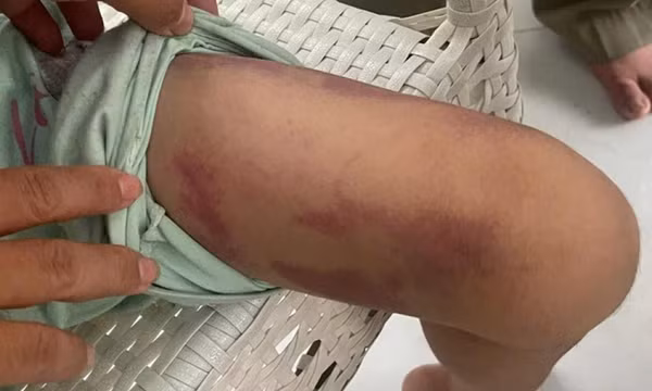 Bé gái 9 tuổi ở TPHCM bị mẹ ruột và bạn trai hành hạ
