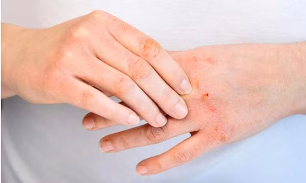 5 biện pháp hiệu quả giúp cải thiện tình trạng viêm da cơ địa