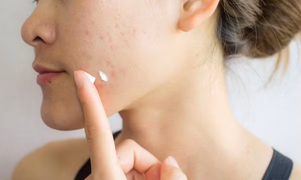 Mụn mãi không hết? Đã đến lúc bạn cần đi khám da liễu!