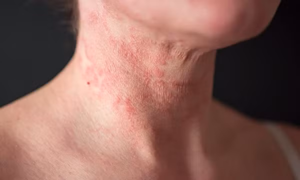 Sáu chất bổ sung cần thiết khi mắc bệnh chàm ngứa