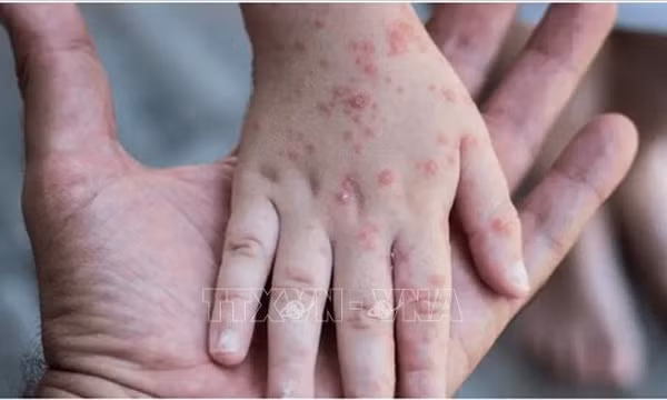 EU cấp chứng nhận CE cho các bộ xét nghiệm bệnh đậu mùa khỉ của Trung Quốc