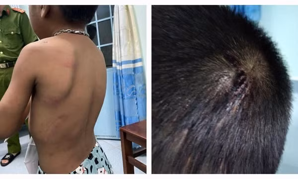 Bé trai 6 tuổi bị cha ruột hành hạ, đánh đập dã man