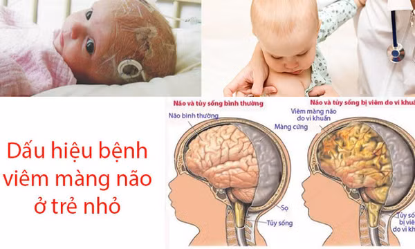 Những dấu hiệu nào báo hiệu bệnh viêm màng não ở trẻ em?