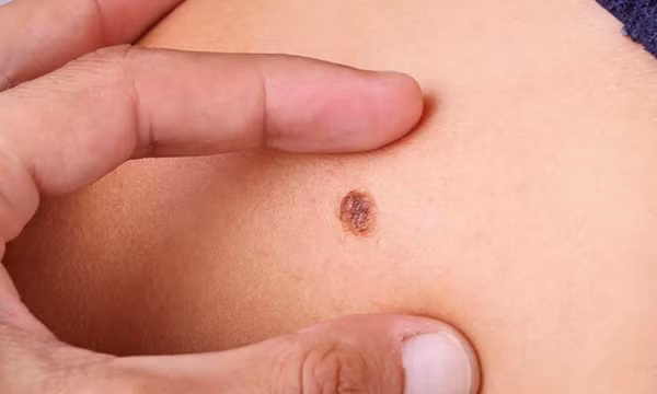 Lý do nguy cơ tử vong do ung thư da ở nam giới cao hơn phụ nữ