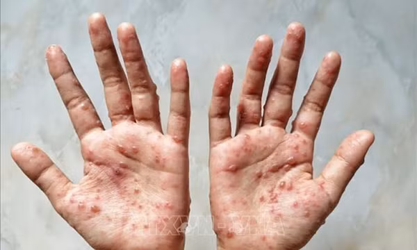 Philippines ghi nhận trường hợp đầu tiên mắc bệnh đậu mùa khỉ
