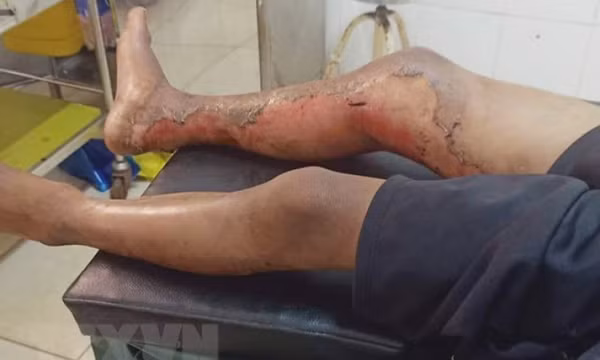 Thông tin thêm về vụ cháu bé 8 tuổi bị bỏng xăng ở Đắk Lắk