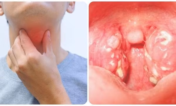 Các biến chứng khó lường của bệnh bạch hầu