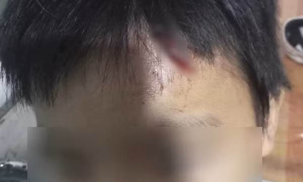 Vừa bị tuyên án 9 tháng tù treo, mẹ kế bị nghi tiếp tục bạo hành con chồng