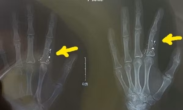 Nhiệt kế vỡ: Nguy hiểm nhiễm độc thủy ngân, nguy cơ lớn nếu dùng máy hút bụi dọn