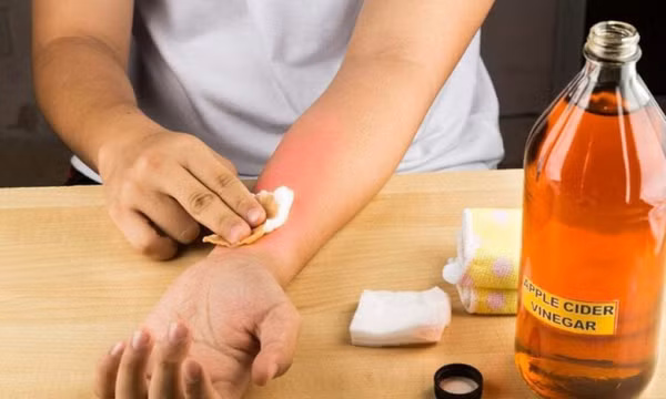 Cách làm dịu tay bỏng rát do dính ớt