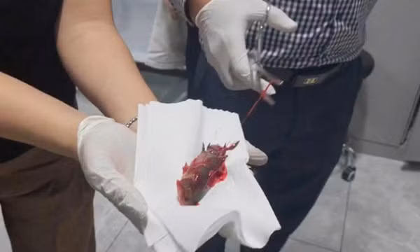 Hy hữu người đàn ông bị cá rô chui vào họng 