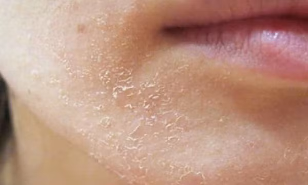 Da khô khi trời lạnh, cấp ẩm thế nào?