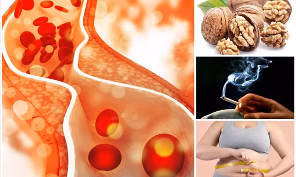 Nguyên nhân tắc nghẽn mạch máu và cách giúp bạn ngăn ngừa