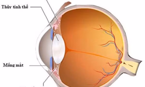 Tìm hiểu những nguyên nhân gây đục thủy tinh thể