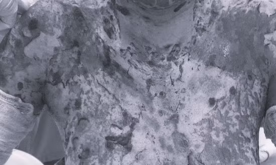 Nổi mẩn đỏ, bóng nước sau khi uống thực phẩm chức năng, bác sĩ chỉ ra nguyên nhân