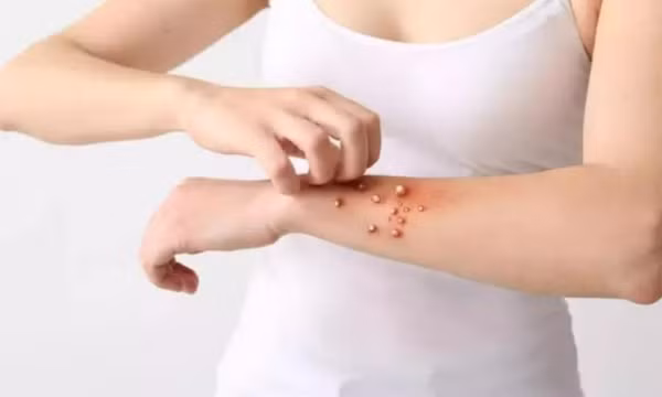 Phân biệt bệnh đậu mùa khỉ và cúm cà chua