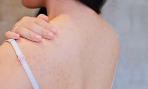 Ngộ độc thuốc gây tê, suýt tử vong vì trị mụn lưng tại spa