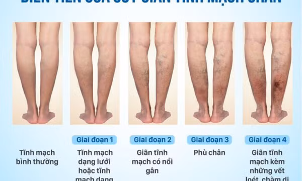 Suy giãn tĩnh mạch chân có chữa khỏi được không, ai có nguy cơ cao mắc bệnh?