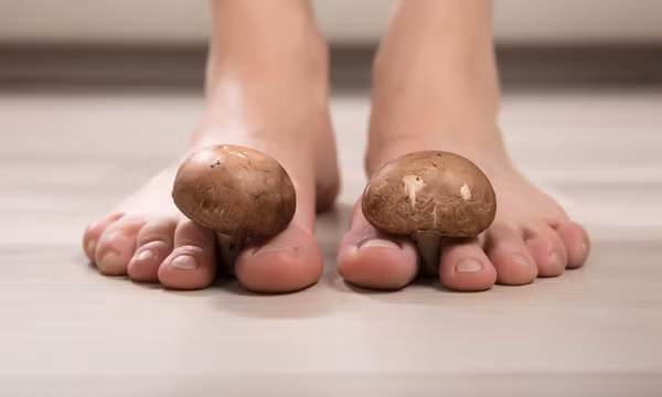 Nước ăn chân mùa mưa và cách xử lý tại nhà hiệu quả nhất