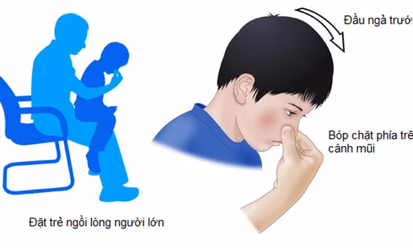 Chảy máu cam ở trẻ: Khi nào cần lo lắng?