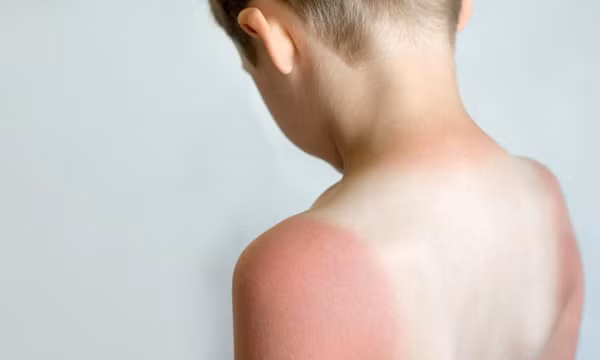 10 tình trạng gây phát ban và sẩn ngứa da mùa hè ở trẻ