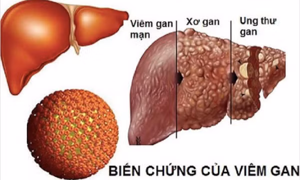 Làm gì để viêm gan B không biến chứng ung thư gan?