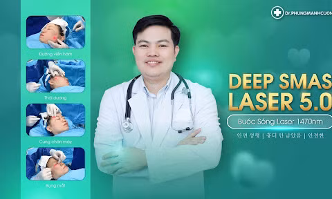 Căng da mặt Deep Smas Laser 5.0 - Phương pháp không phẫu thuật mới 
