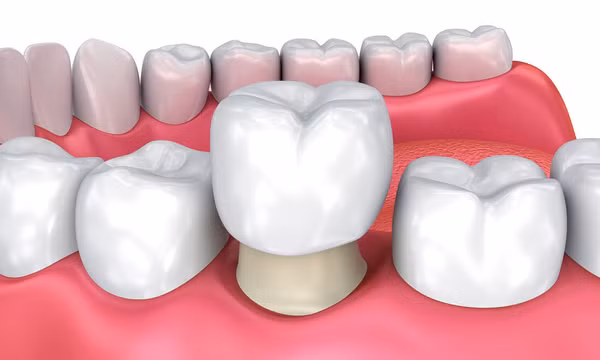 8 mối nguy từ việc bọc răng sứ không đảm bảo chất lượng