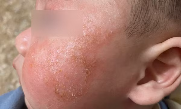 Kiêng tắm 6 ngày khi mắc Covid-19, da trẻ đóng vảy, đỏ lừ