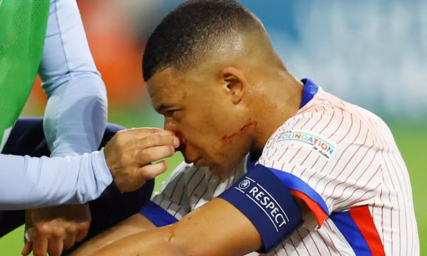 Pháp tổn thất nặng khi Mbappe bị gãy mũi