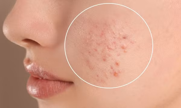 6 biểu hiện ở da cho thấy bạn đang thiếu vitamin