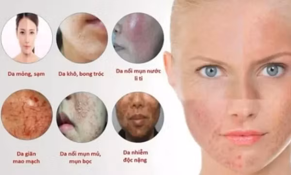 Nhận biết làn da bị "nhiễm độc" corticoid