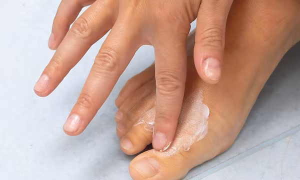 4 bệnh nấm da dễ gặp khi mùa mưa đến