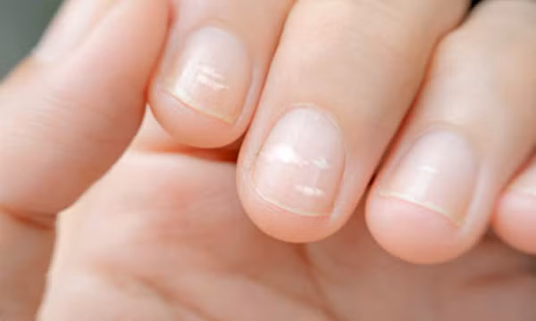  Không phải xem chỉ tay, nhìn móng tay của mình thuộc loại nào trong 7 kiểu dưới đây sẽ giúp bạn đoán được sức khỏe của bản thân
