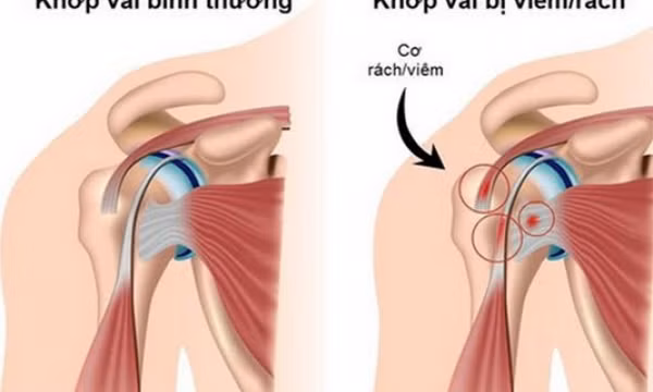 Ứng phó với viêm quanh khớp vai