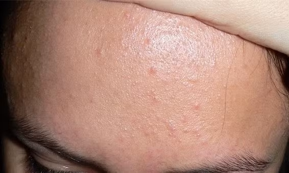 Nguyên tắc điều trị mụn ẩn bạn cần nhớ