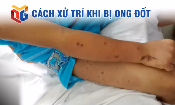 Cách xử trí khi bị ong đốt