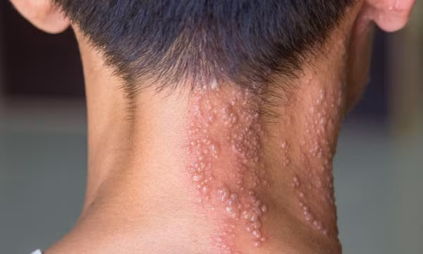 Cảnh báo, bệnh zona có thể gây viêm màng não