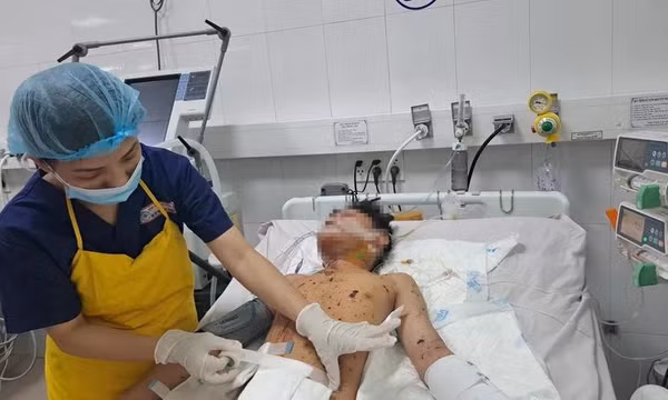 Nhiều trẻ em nhập viện do tự chế pháo dịp cận Tết