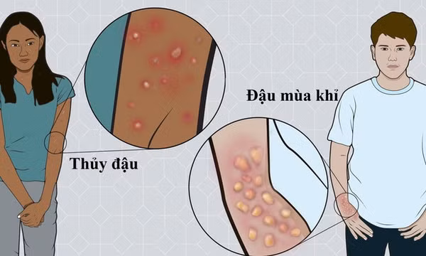 Phân biệt thủy đậu và đậu mùa khỉ