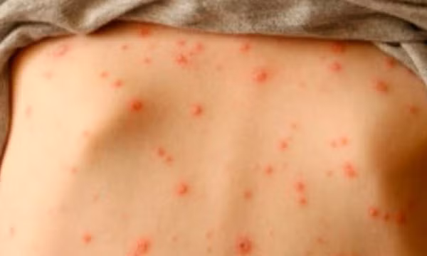 Mắc bệnh thủy đậu rồi có bị lại không?
